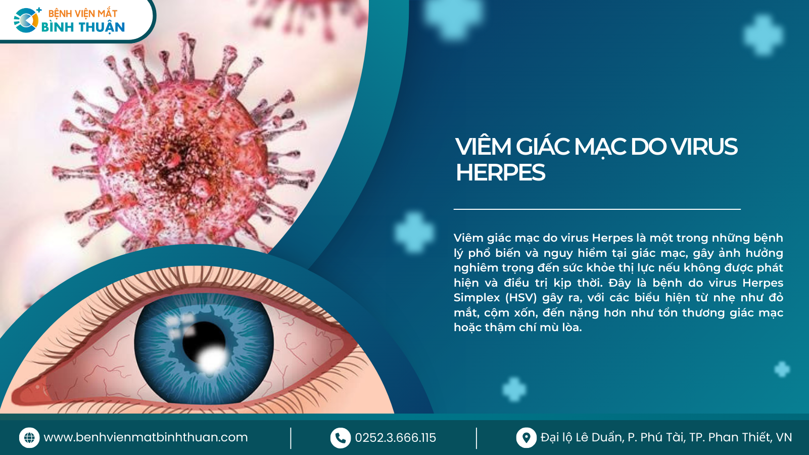 Viêm giác mạc do virus herpes