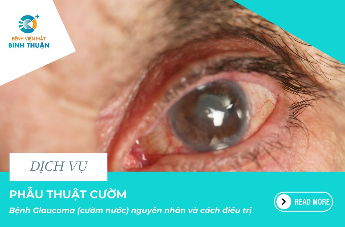 Bệnh glaucoma (cườm nước) nguyên nhân và cách điều trị