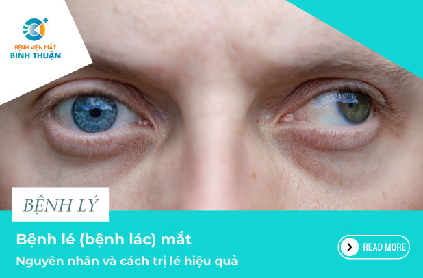 Bệnh lé (bệnh lác) mắt: Nguyên nhân và cách trị lé hiệu quả