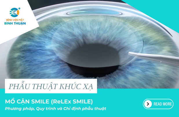 Mổ cận SMILE: Phương pháp, quy trình và chỉ định phẫu thuật