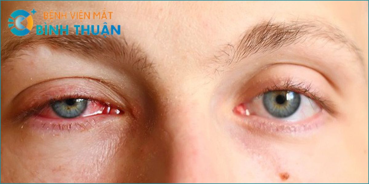 BỆNH GLAUCOMA (CƯỜM NƯỚC) NGUYÊN NHÂN VÀ CÁCH ĐIỀU TRỊ