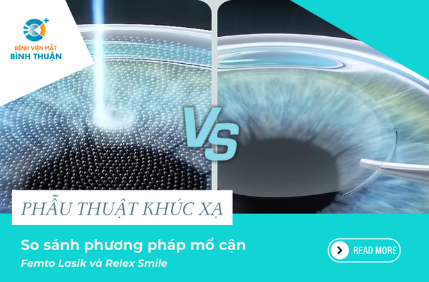 So sánh phương pháp mổ cận Femto Lasik và Relex Smile