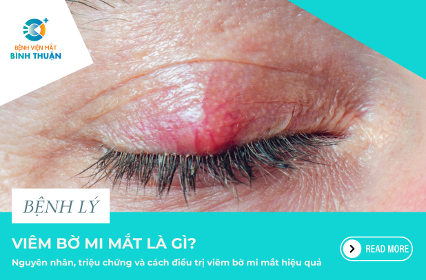 Viêm bờ mi mắt: Nguyên nhân, triệu chứng và phương pháp điều trị hiệu quả